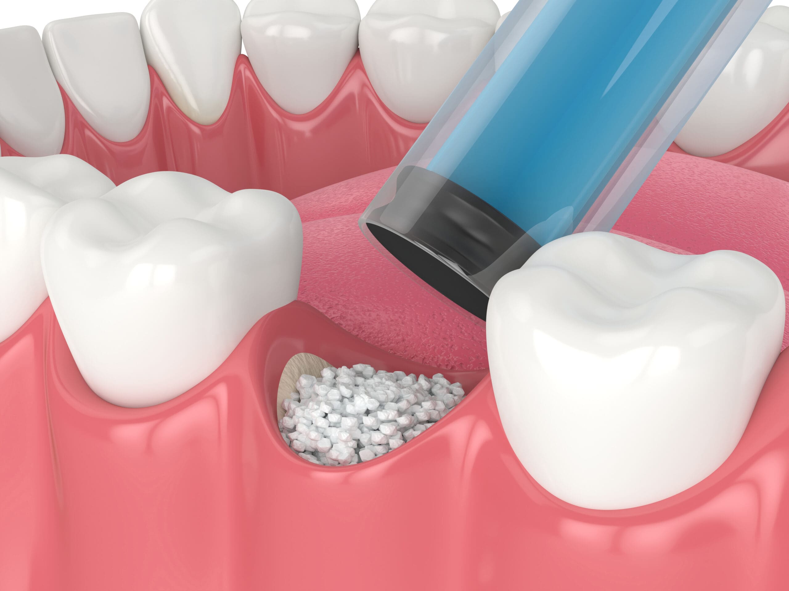 Dental Implants and Restorations