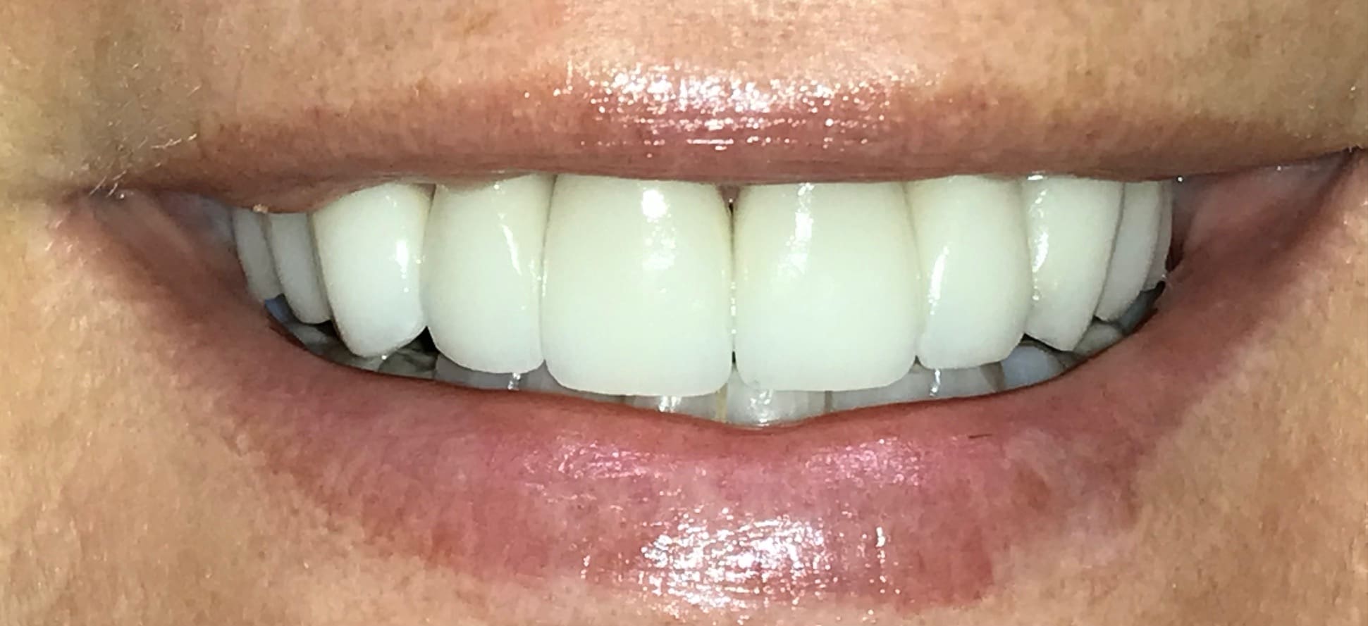 Veneers After